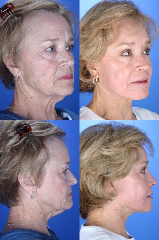 Before and After Image: Facelift - front