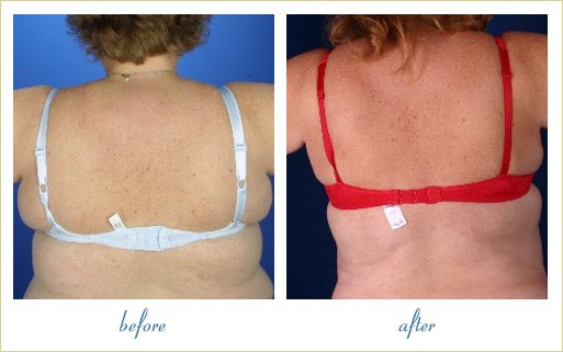 Before and After Image: Liposuction - back
