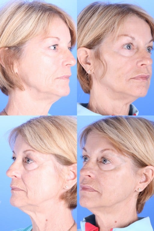 Before and After Image: Liquid Facelift - front